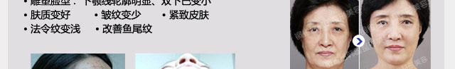 热玛吉除皱紧致效果
