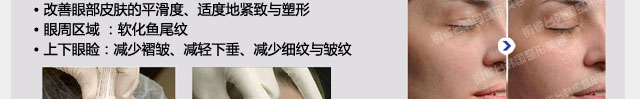 热玛吉除皱紧致效果
